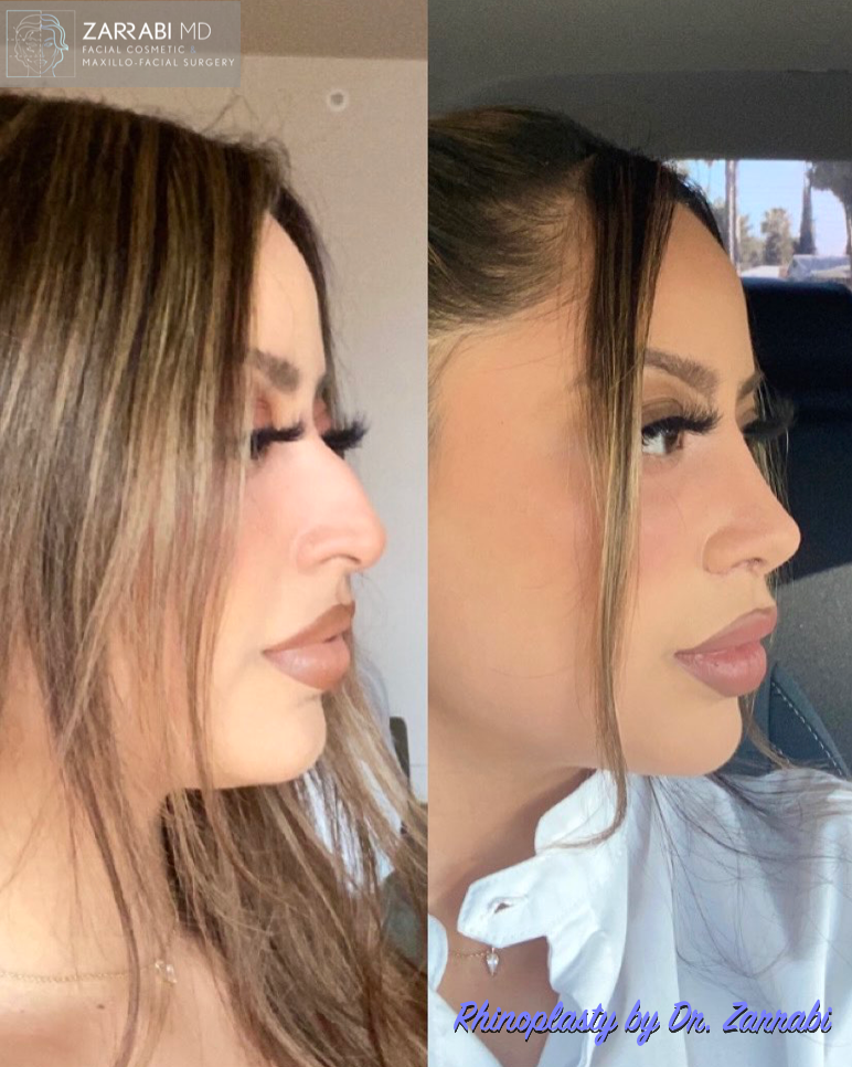 Piezo Rhinoplasty