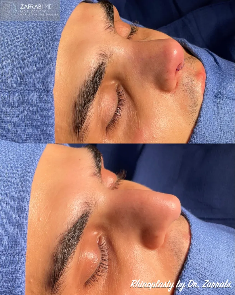 Ultrasonic Piezo Rhinoplasty 4 1