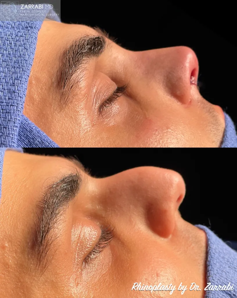 Ultrasonic Piezo Rhinoplasty 4 2