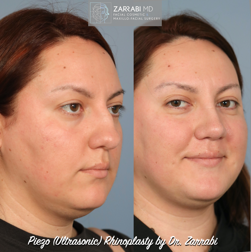 Ultrasonic Piezo Rhinoplasty 5 2 1