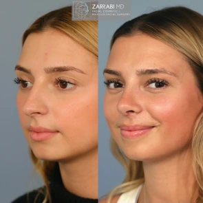 open piezo rhinoplasty 1 1