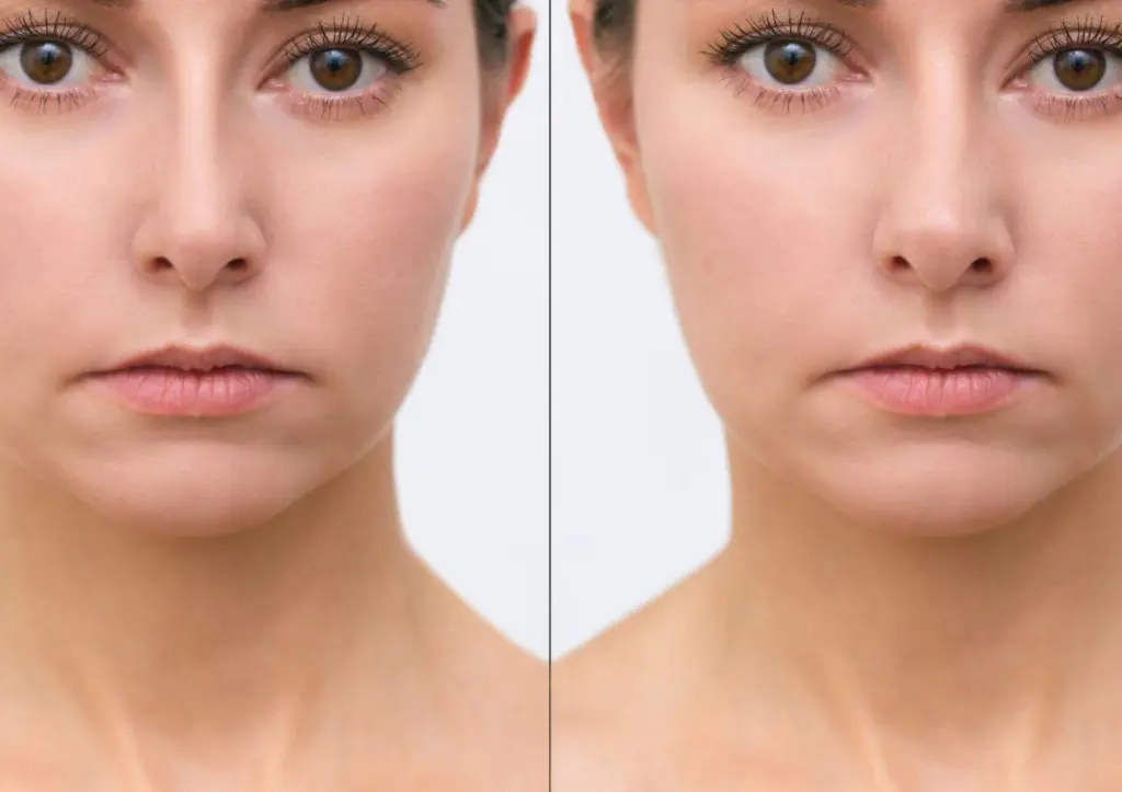 Crooked Nose Rhinoplasty in California | Dr. Shahrouz